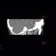 Menigioma en plaque, sphenoid bone: CT - Computed tomography